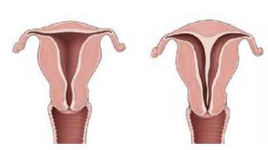 Rahimde Perde Olması (Septum Uterus) Gebeliğe Engel midir?