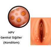 Hamilelikte Genital Siğiller: Neden Olur, Nasıl Tedavi Edilir?