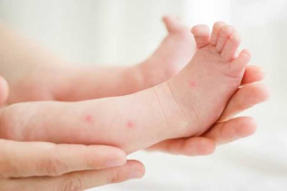 Bebeklerde Sivrisinek Isırığına Ne İyi Gelir?