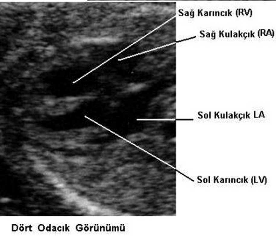 Hamilelikte Yapılan Ultrason Terimleri Ne Anlama Geliyor?