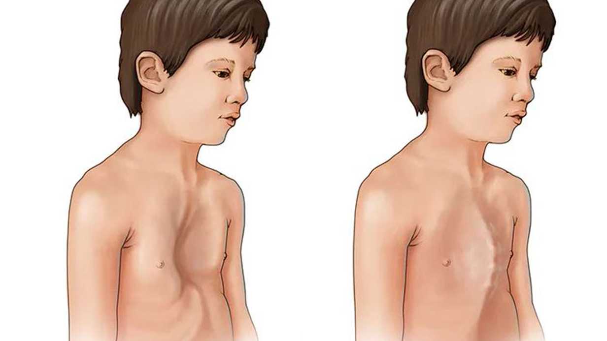 Marfan Sendromu Nedir? Belirtileri, Nedenleri ve Tedavisi