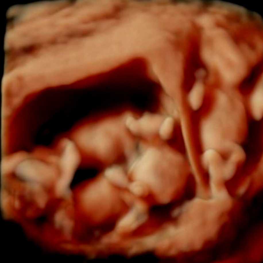Üçüz Bebeğe Hamile Olan Anne Adayları Nasıl Doğum Yaparlar?
