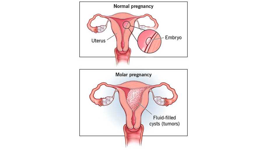 Molar Gebelik Nedir? Belirtileri, Nedenleri ve Tedavisi