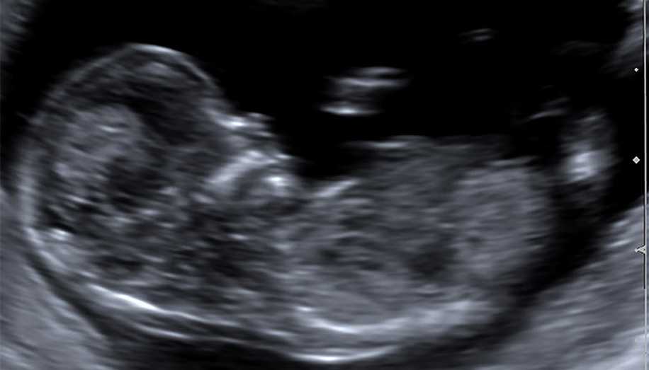 Hamileyken Bebeğinizin Kız Olduğunu Anlamanın 14 Farklı Yolu