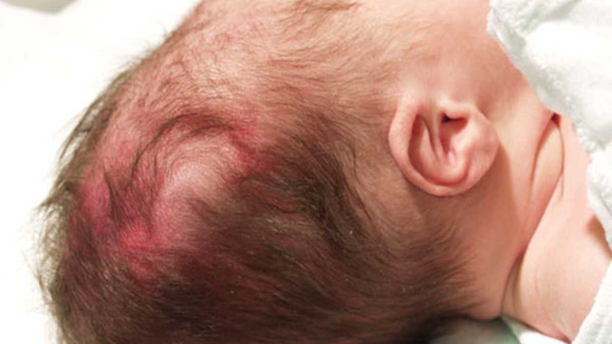 Doğumdan Sonra Bebeğin Kafasındaki Şekil Bozukluğu & Şişlik