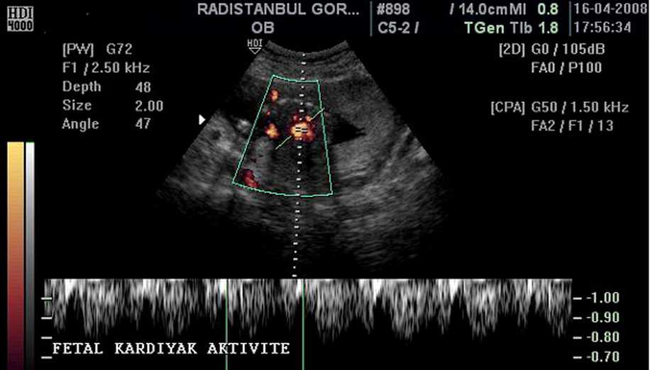 Hamilelikte Yapılan Ultrason Terimleri Ne Anlama Geliyor?