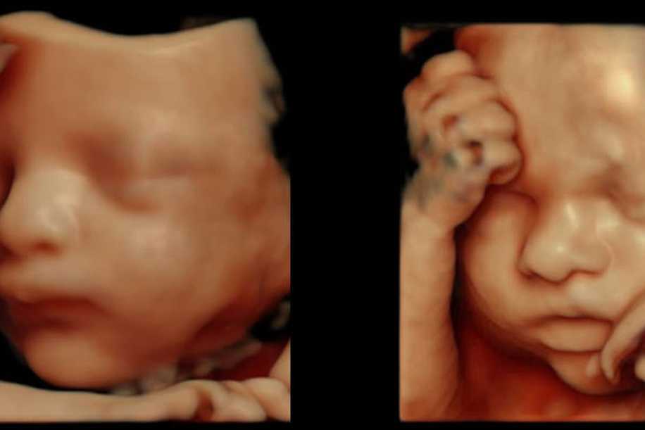 Hamilelikte Renkli Ultrason Neden ve Ne Zaman Yapılır?