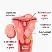 Hamilelikte Miyomun Riskleri ve Doğum Yöntemine Etkisi