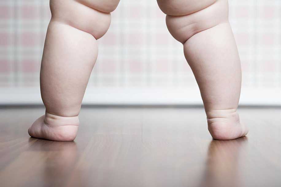 Bebeklerde Bacak Eğriliği (Parantez Bacak) Nasıl Tedavi Edilir?