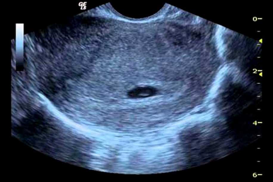 Bebek Ultrasonda İlk Defa Kaçıncı Haftada Görülür?