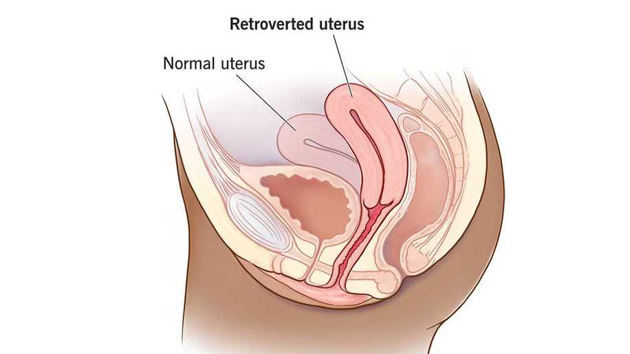 Ters Rahim Nedir? Hamileliğe Engel Olur mu?