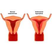 Endometrial Hiperplazi Nedir?