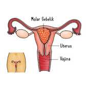 Molar Gebelik Nedir? Belirtileri, Nedenleri ve Tedavisi