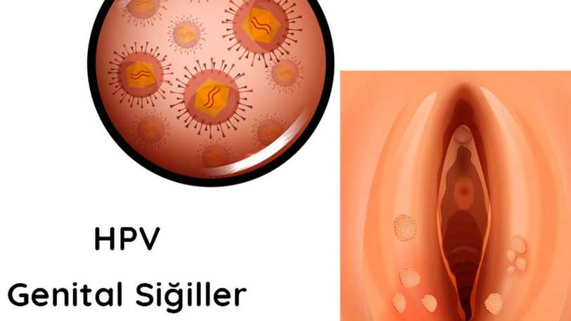 Hamilelikte Genital Siğiller: Neden Olur, Nasıl Tedavi Edilir?