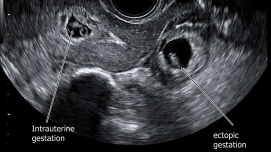 Heterotopik Gebelik Nedir? Nedenleri, Belirtileri ve Tedavisi