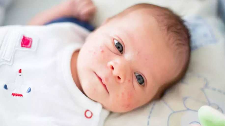 Bebeklerde Sivilce: Neden Olur ve Nasıl Tedavi Edilir?