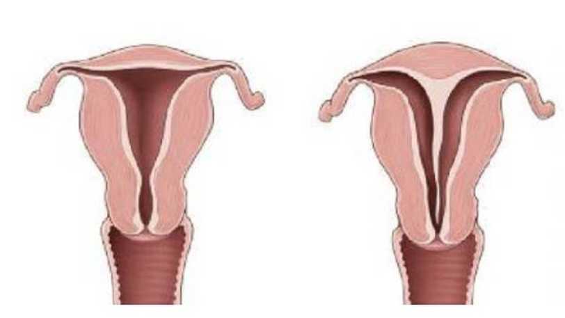 Rahimde Perde Olması (Septum Uterus) Gebeliğe Engel midir?