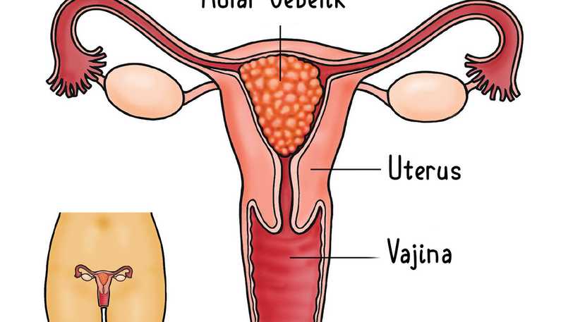 Molar Gebelik Nedir? Belirtileri, Nedenleri ve Tedavisi