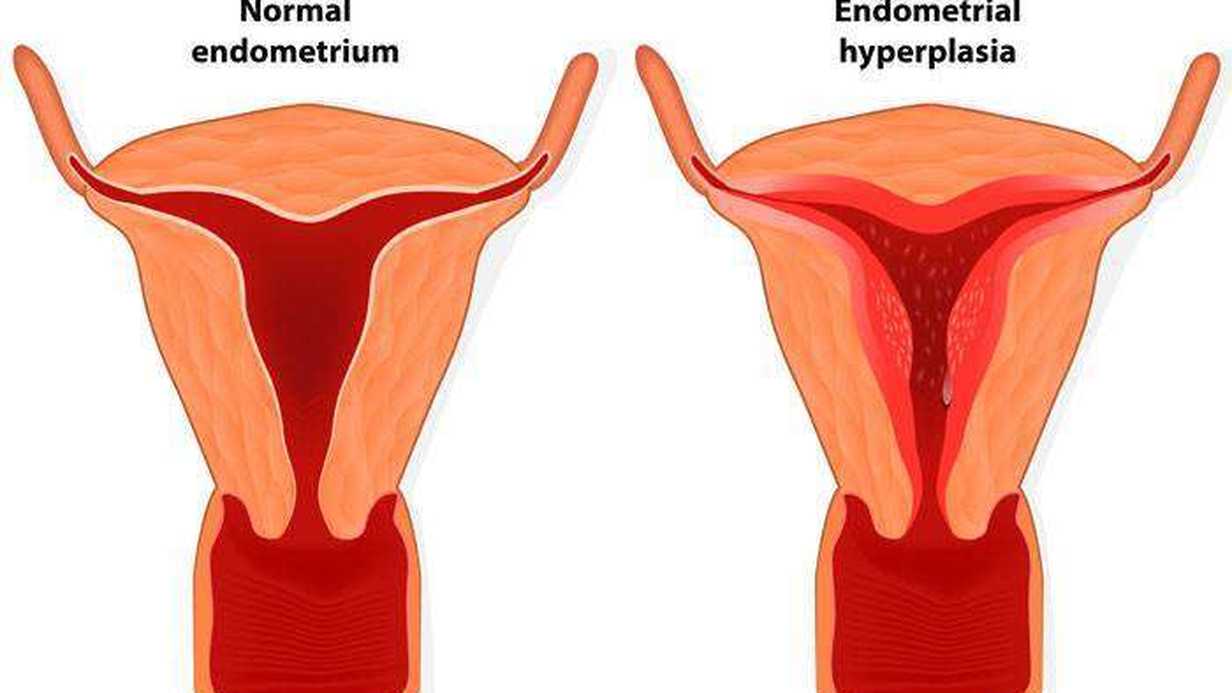 Endometrial Hiperplazi Nedir?