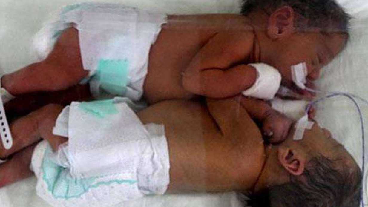 Ankara'da Yapışık İkizler Tek Karaciğerle Dünyaya Geldi