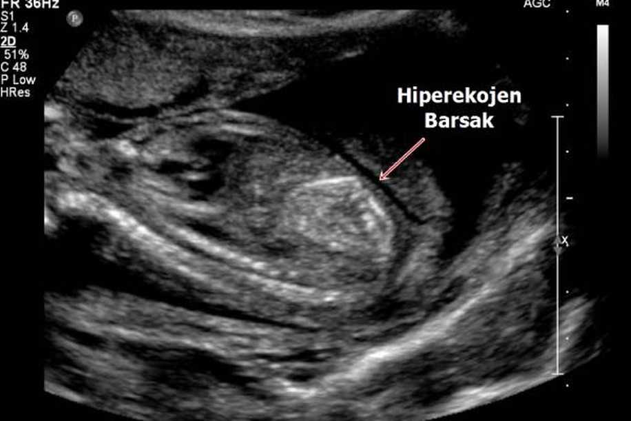 Ultrasonda Bebeğin Bağırsağında Parlaklık Olması Ne Anlama Geliyor?