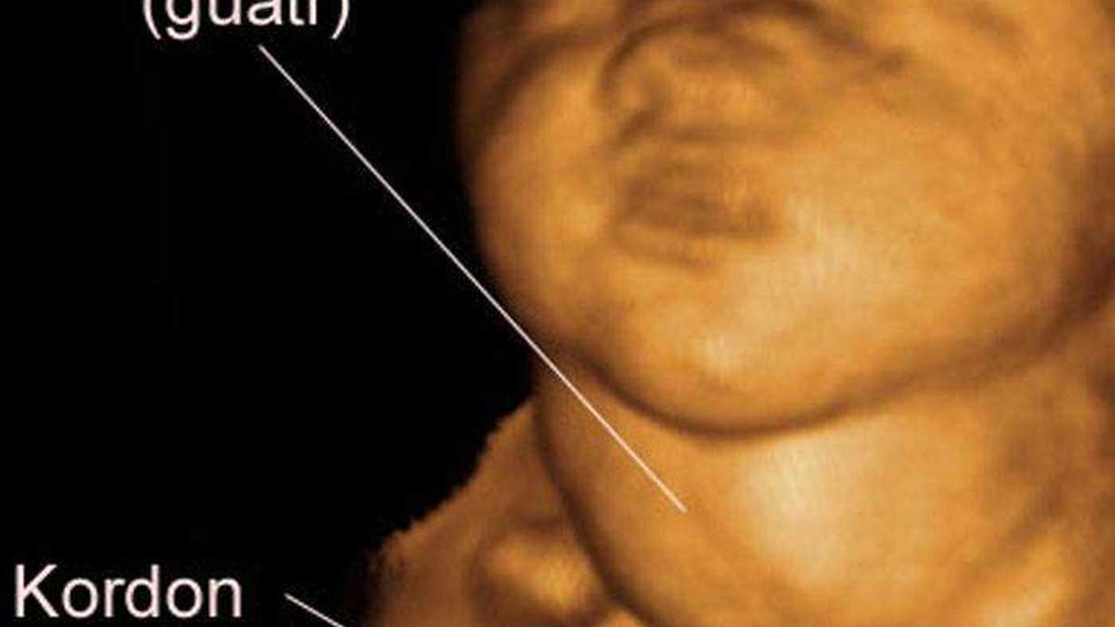 Fetal Guatr Nedir?