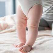 Bebeklerde Bacak Eğriliği (Parantez Bacak) Nasıl Tedavi Edilir?