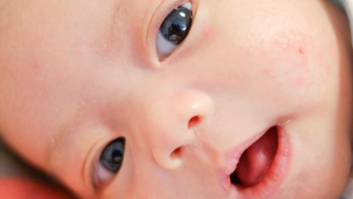 Bebeklerde Sivilce: Neden Olur ve Nasıl Tedavi Edilir?