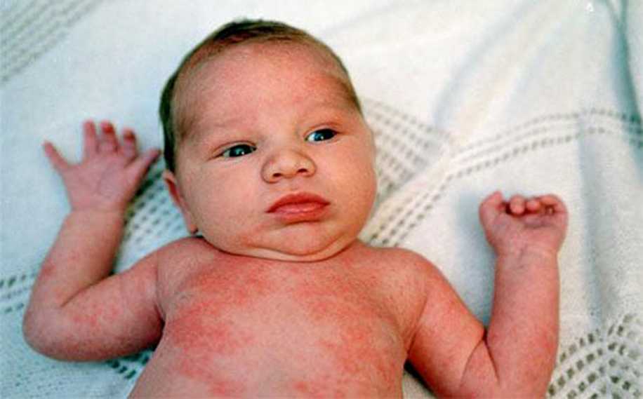 Bebeklerde Alerji Türleri ve Tedavi Şekilleri