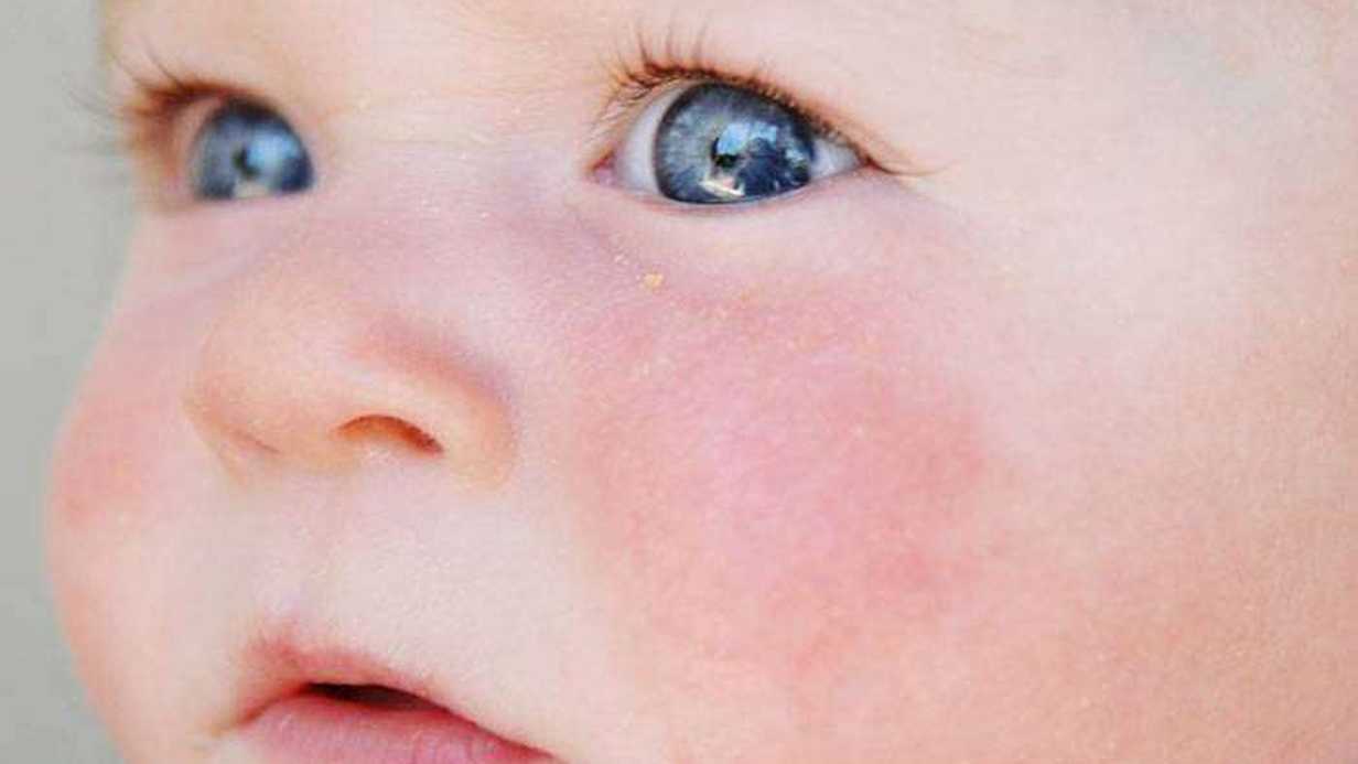 Bebeklerde Güneş Yanıkları Nasıl Önlenir?