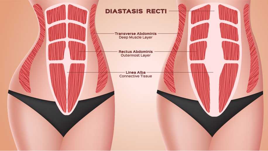 Diastasis Recti (Karın Kası Ayrılması) Nedir?