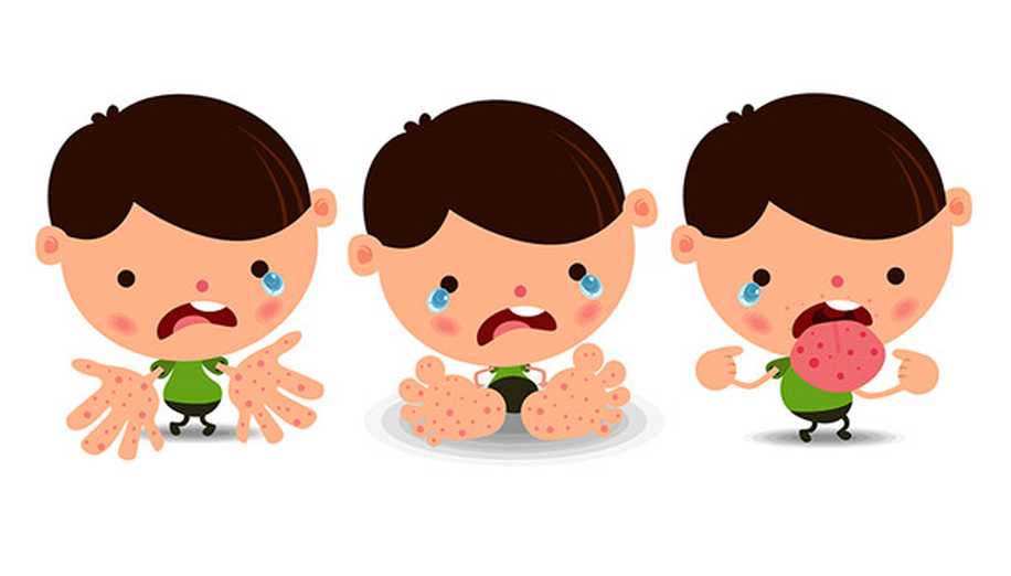 Bebeklerde El Ayak Ağız Hastalığı Belirtilerine Dikkat!