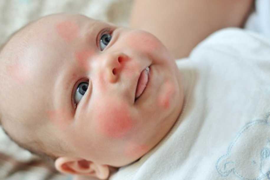 Bebek Alerjilerinden Kaçınmanın 4 Yolu